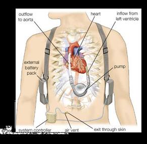left ventricular assist device